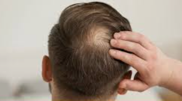 Tips for Hair Care: नारियल तेल का इस्तेमाल करने से गंजे सिर पर भी बाल उग आएंगे